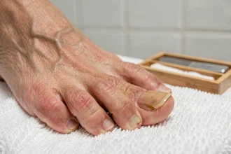 Gros plan sur un ongle de pied épais et jauni après une mycose, reposant sur une serviette blanche avec un kit de soin des ongles en arrière-plan
